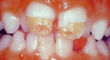 Enamel Defects in the Permanent Dentition: Prevalence and Etiology