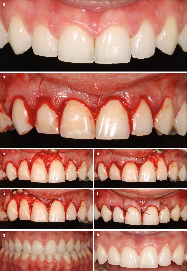 Esthetical Clinical Crown Lengthening, Lip Repositioning, and Gingival