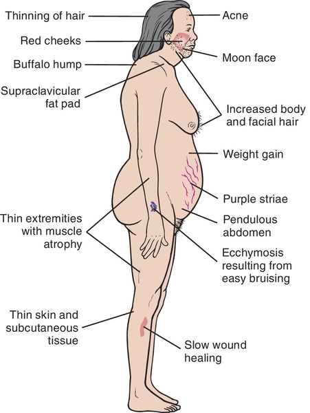 Oral Glucocorticoid 104