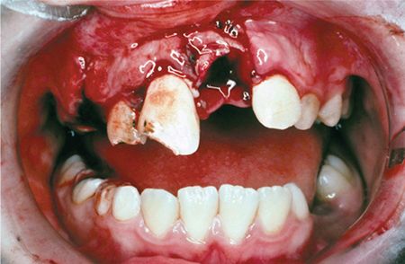 Oral sex teeth and injury