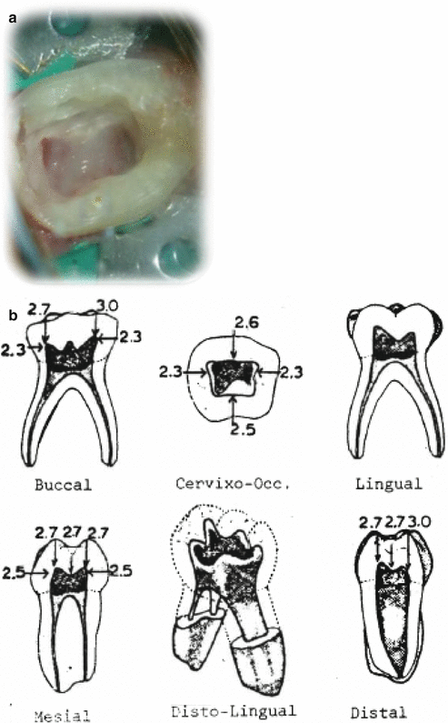 Pulpectomy and Root Canal Treatment (RCT) in Primary Teeth: Techniques