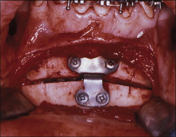Role of Orthodontics in Obstructive Sleep Apnea | Pocket Dentistry