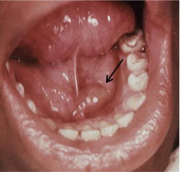 Hard Lump On Floor Of Mouth Under Tongue Home Alqu