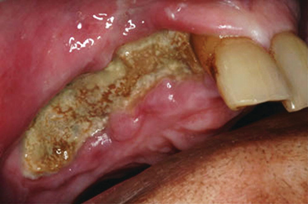 Photo of teeth with osteonecrosis in the maxilla.
