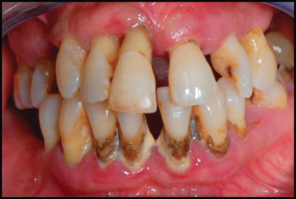 Photo of teeth with 4 incisors displaying periodontal disease.