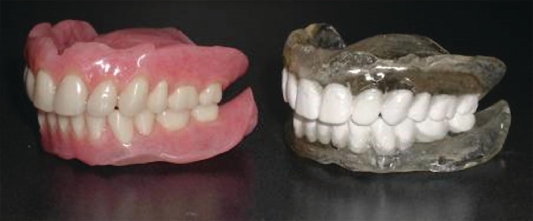 Photo of two teeth prostheses displaying screw‐retained (left) vs. cement‐retained (right) restorations.