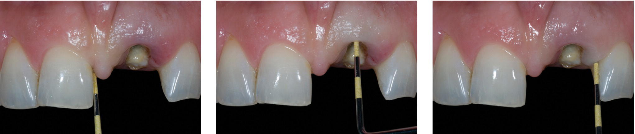 Three photos of upper set of teeth with missing left central incisor depicting osseous–gingival tissue relationship evaluated by bone sounding.