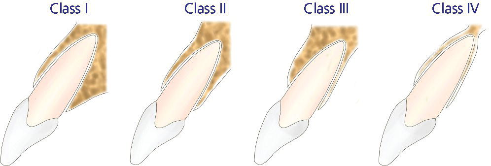 Illustration of four different classes of sagittal root position each labeled starting from (left to right) Class I, Class II, Class III, and Class IV.