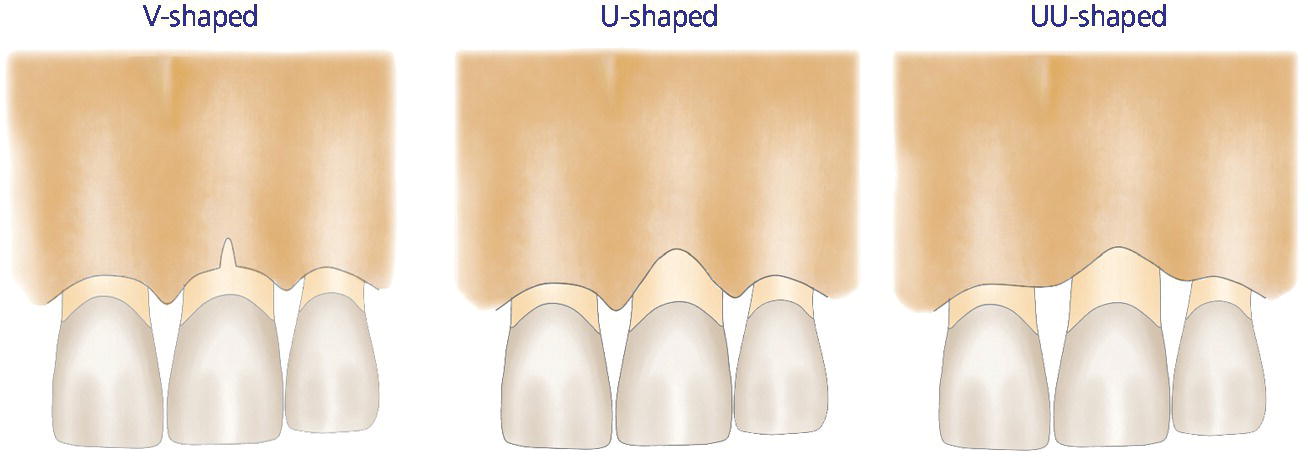 Illustration of facial bone defect classification: U-shaped defect (left), V-shaped defect (center), and UU-shaped defect (right).