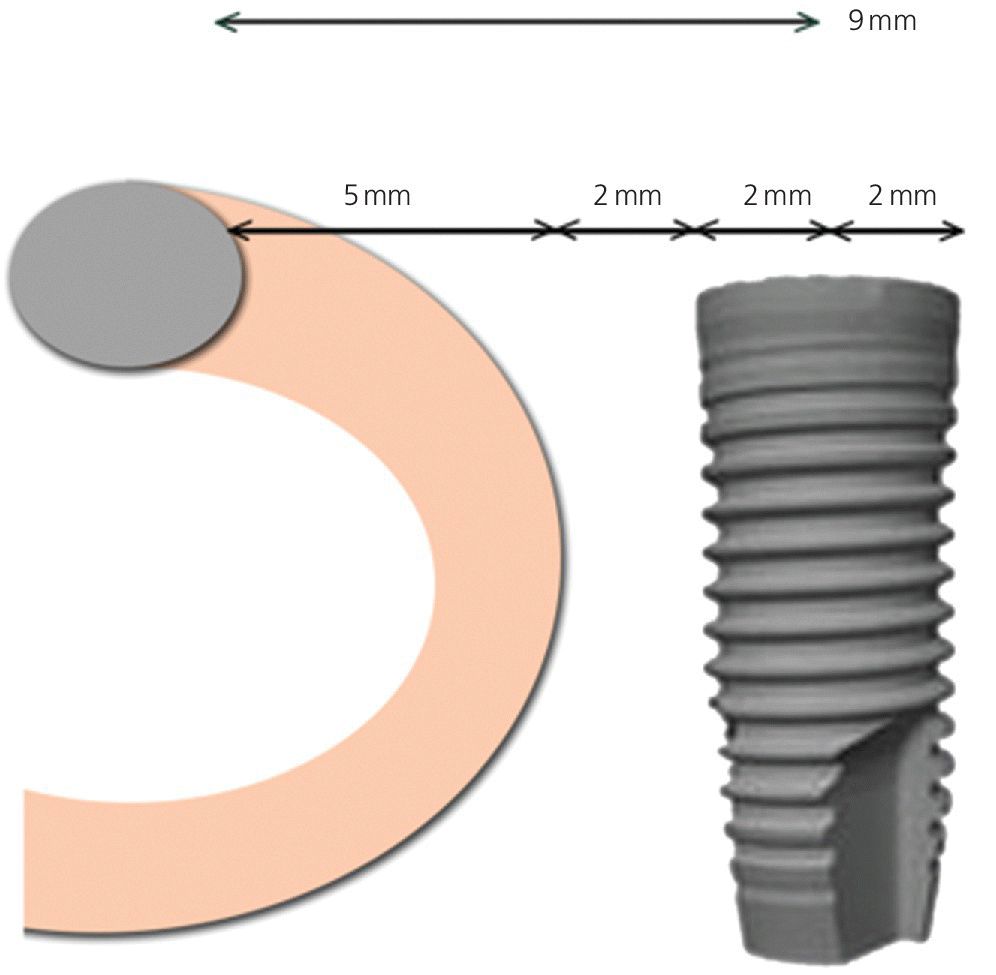 Diagram illustrating the placement of the inferior‐most point of the implant 9 mm anterior to the mental foramen.