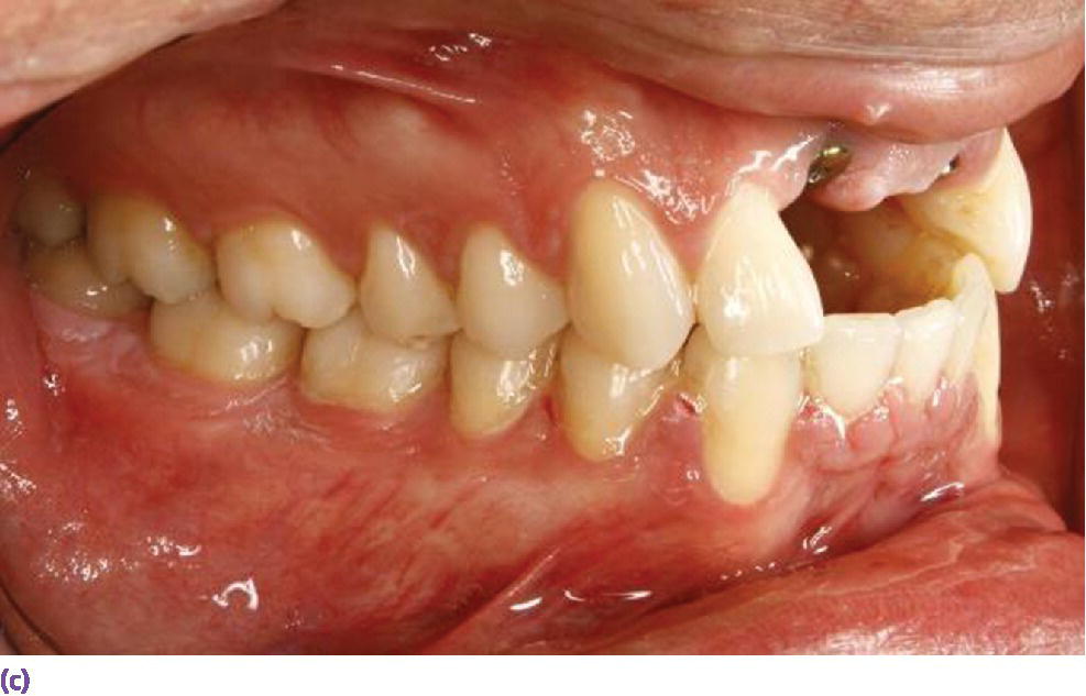 Photo displaying orthodontic intrusion of mandibular incisors to accommodate maxillary anterior restorative requirements and harmonious crown morphologies.