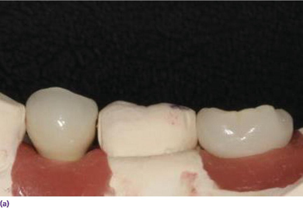 Photo displaying a side view representation for screw-retained restorations (top left) using the required minimum of 5 mm interocclusal space.