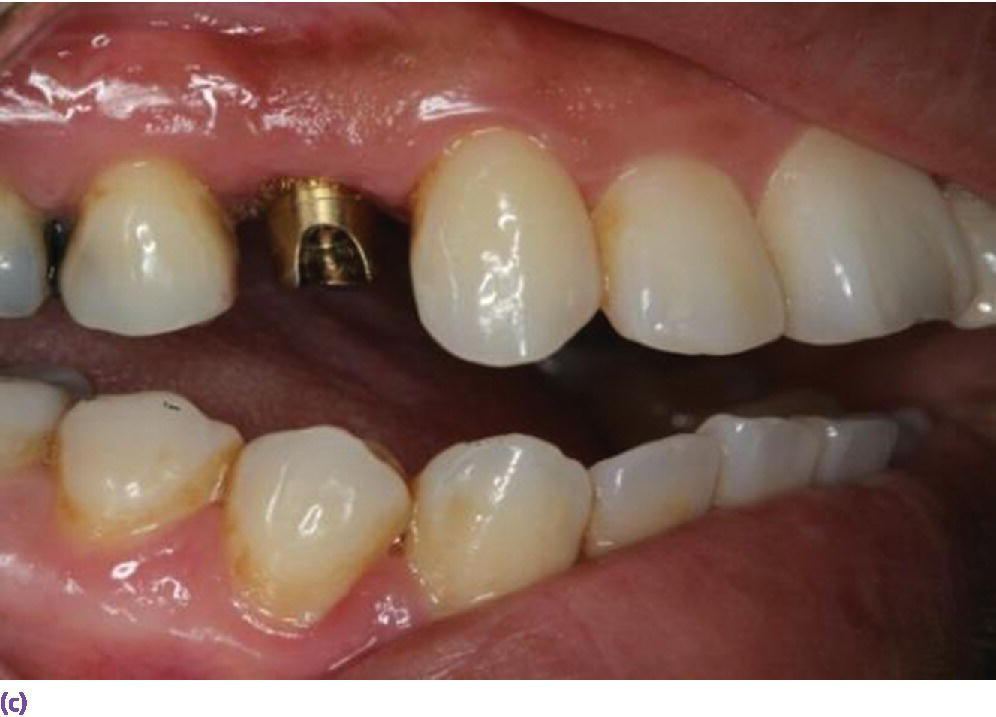Photo displaying right side view representation of a 5 mm high screw abutment on the first cuspid area for a cement-retained crown with a required minimum of 7 mm interocclusal space.