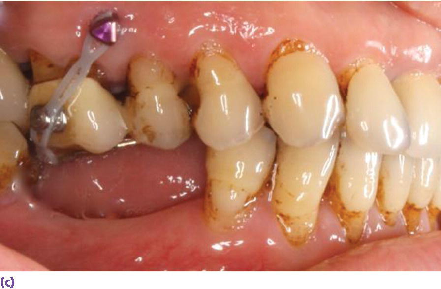 Photo displaying the use of buccal and palatal temporary anchorage devices (TADs) for intrusion with expected movement of 0.5–1 mm per month for adults.