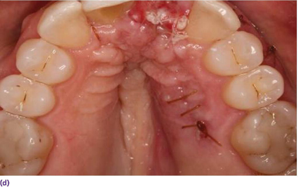 Photo displaying the palatal donor site (sutured) for graft.