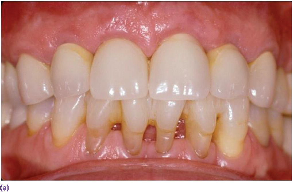 Photo of maxillary and mandibular teeth displaying  individual porcelain-fused-to-metal crowns on sites #7, 8, 9, and 10 implants.