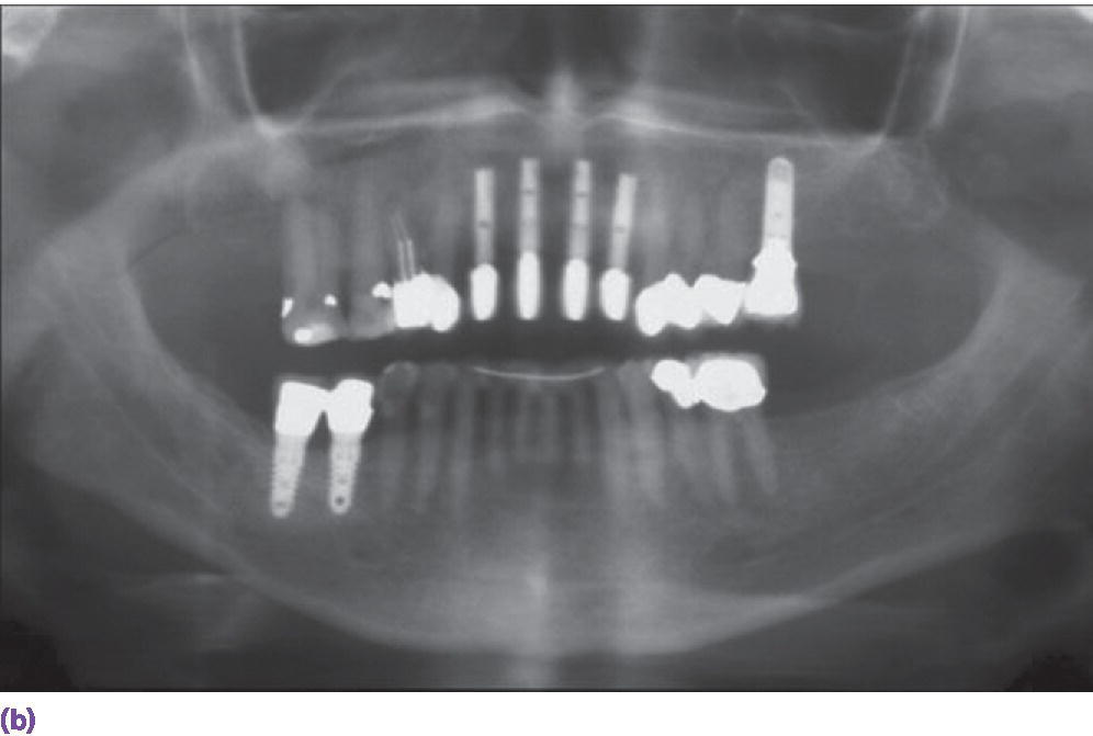 Radiograph of teeth displaying a platform-switched abutment design.