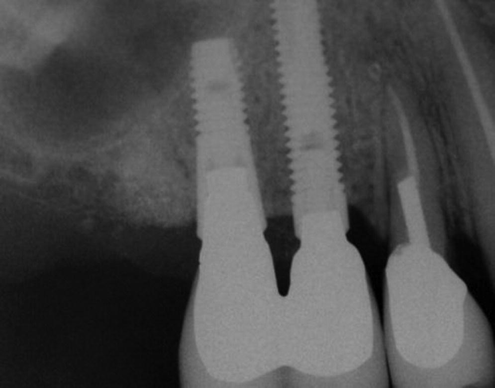 Radiograph of an interproximal bone preserved with a natural tooth (site #5) adjacent to two implants (sites # 6 and 7).