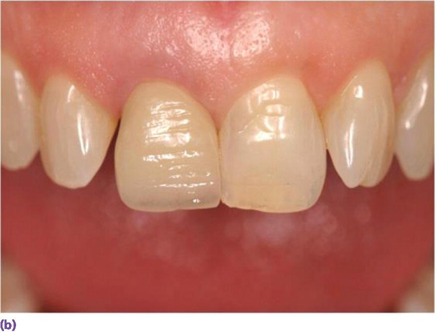 Photo of maxillary teeth displaying a single implant ceramic crown replacing left maxillary central incisor teeth.