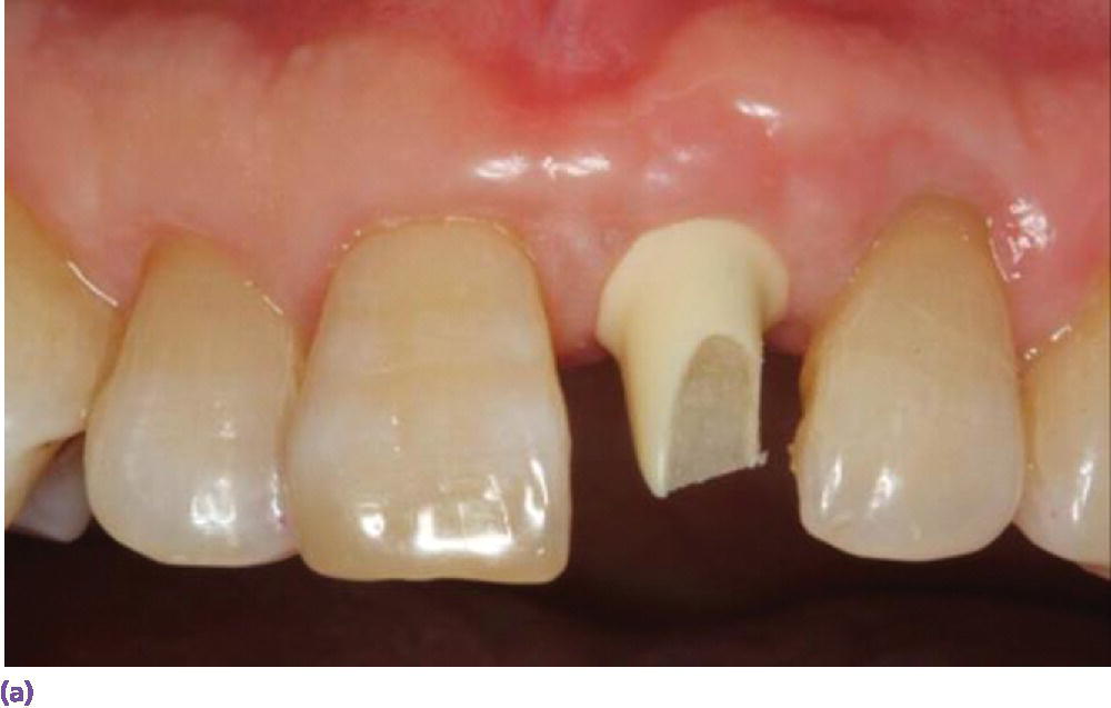 Photo of maxillary teeth depicting zirconia abutment positioned between right central incisor and canine teeth.