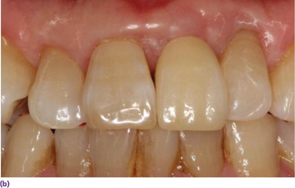 Photo of teeth from frontal view displaying  an all-ceramic crown restoration of the right maxillary lateral incisor.