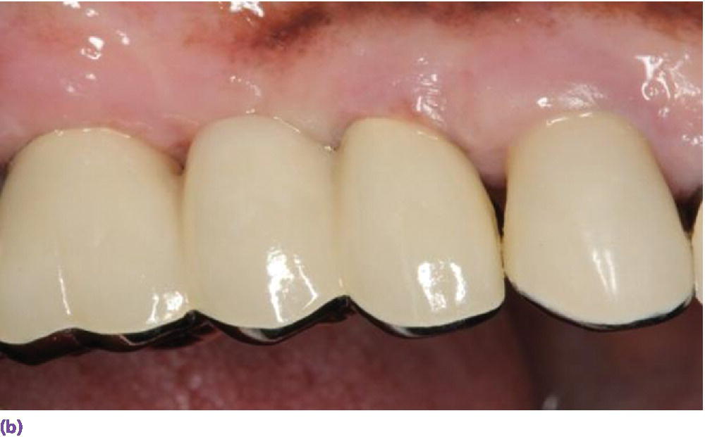 Photo of gum and four implants displaying a two-unit implant-supported fixed dental prosthesis with 2 porcelain-fused-to-metal crowned implants placed side by side.