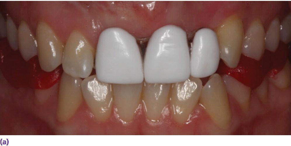 Photo of a gum and the maxillary (upper) and mandibular (lower) teeth displaying GC resin occlusal jig.