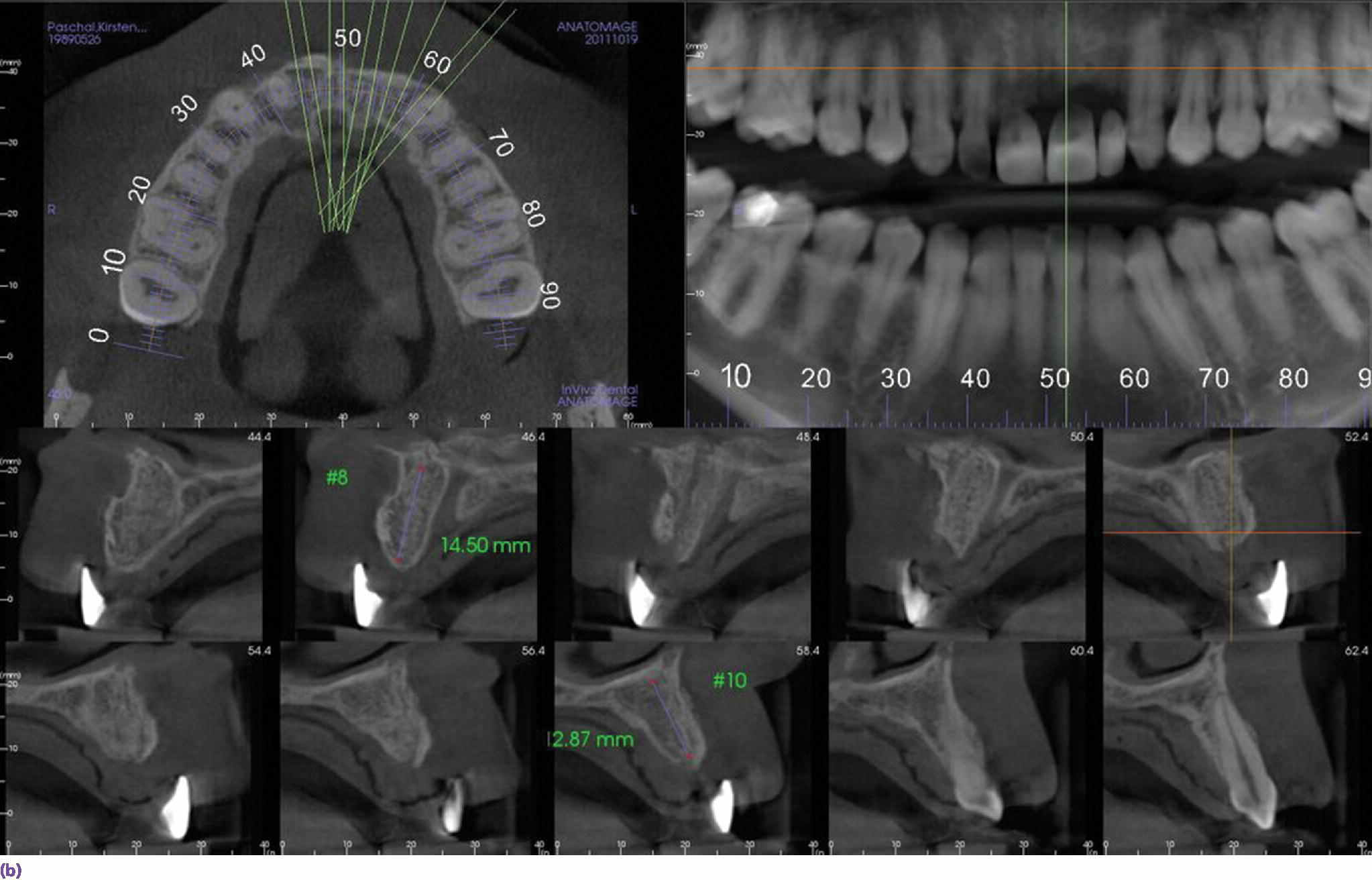 Radiographs displaying the sagittal section through site #9. They feature the exact relation of the proposed final restoration position to the available bone bed.