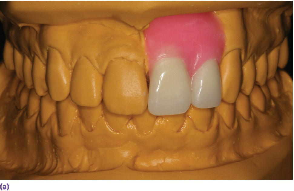 Photo of diagnostic wax-up for the proposed definitive restorations on maxillary left central and lateral incisors displaying the crown of teeth 9 and #10 waxed up.