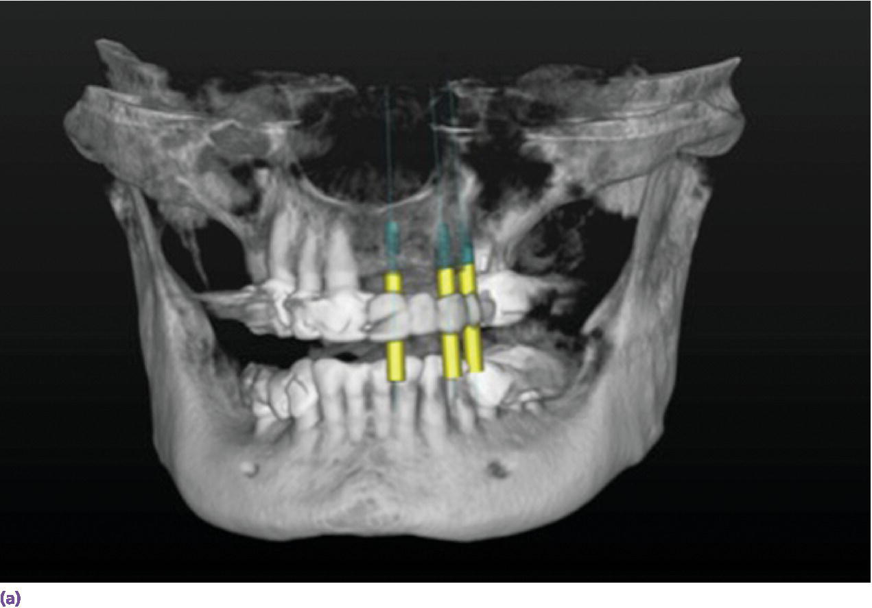 Screen capture displaying computer-generated 3-dimensional virtual implant planning.