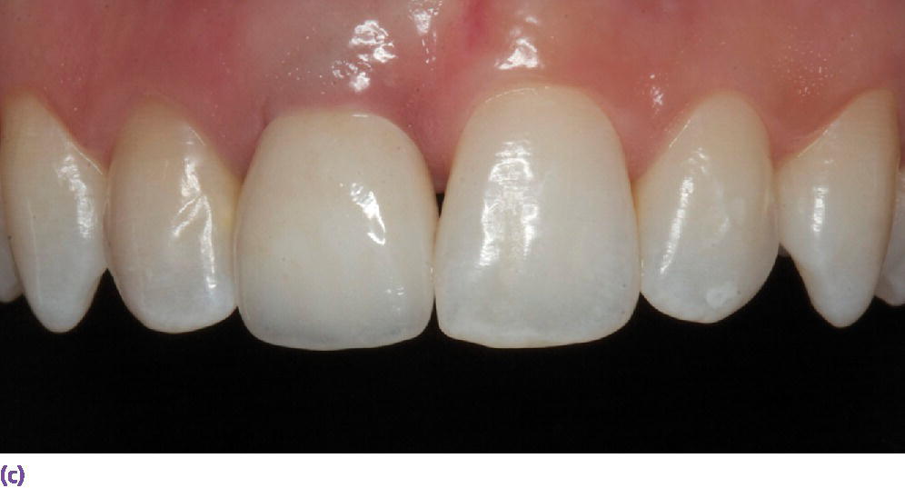 Photo of facial view of definitive implant restoration with asymmetrical gingival zenith resulting from inadequate implant placement.
