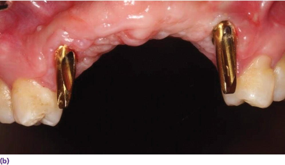 Photo displaying the definitive abutments with gold hue in place.