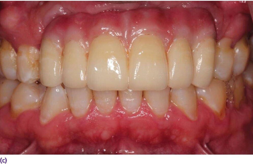 Photo displaying the use of pink ceramics to compensate for the lost tissues and provide an optimum esthetic result.