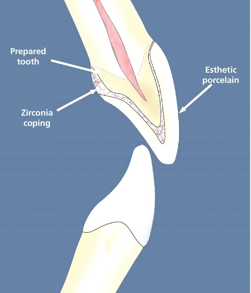 Illustration of cross‐section layered zirconia crown depicting zirconia and veneering porcelain labeled prepared tooth,zirconia coping, and esthetic porcelain.