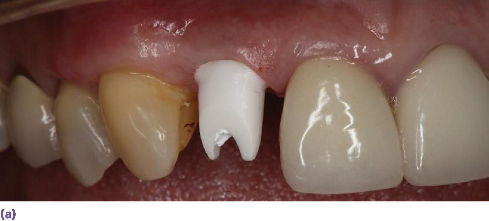 Photo displaying zirconia CAD/CAM abutment in place.