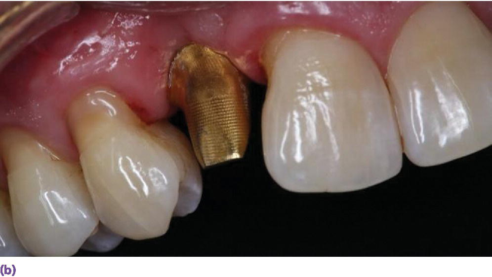 Photo displaying gold hue abutment in place.