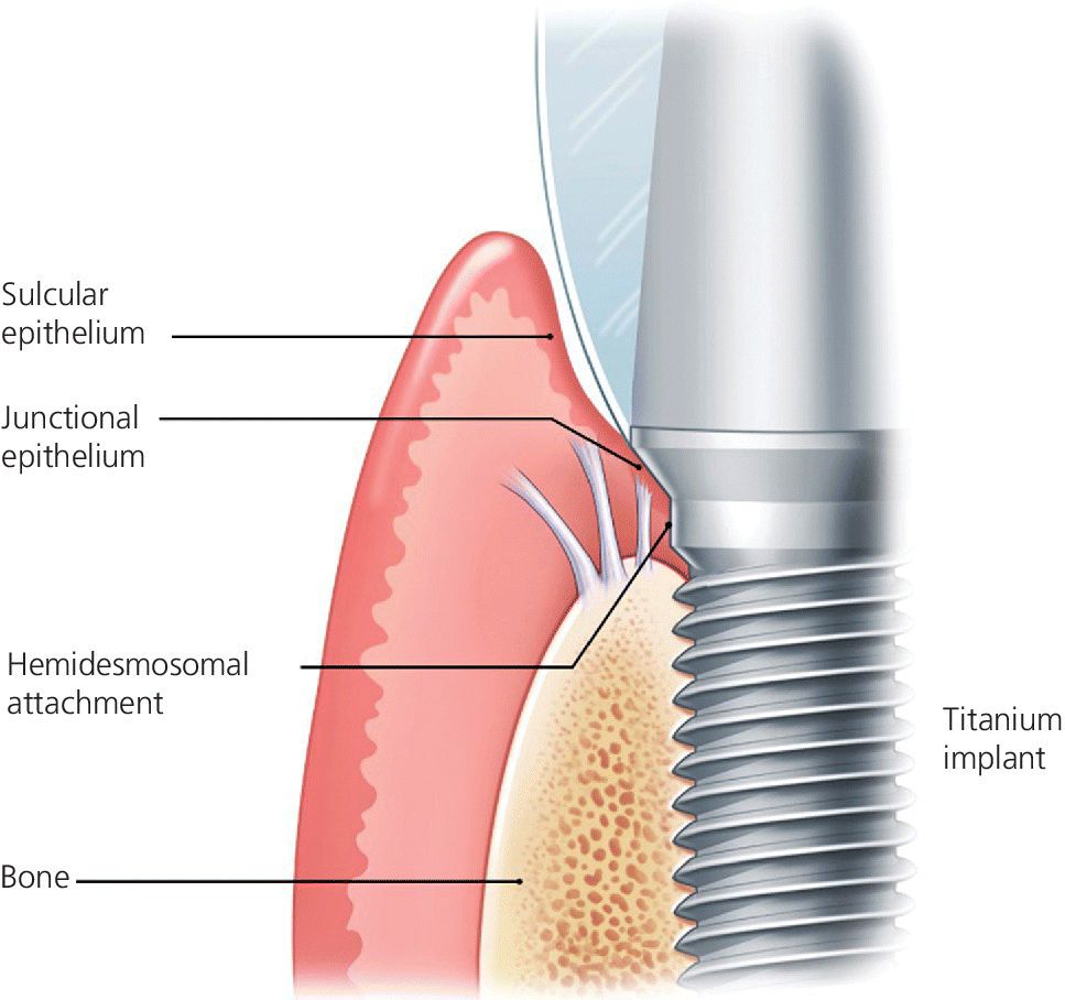Illustration of biological attachment to a dental implant with lines pointed to sulcular and junctinal epithelium,hemidesmosal attachment,etc.