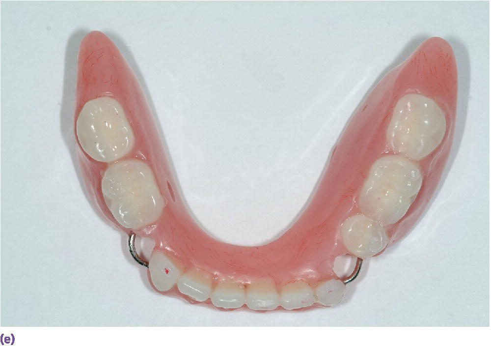 Photo displaying provisional removable partial denture for the mandible.