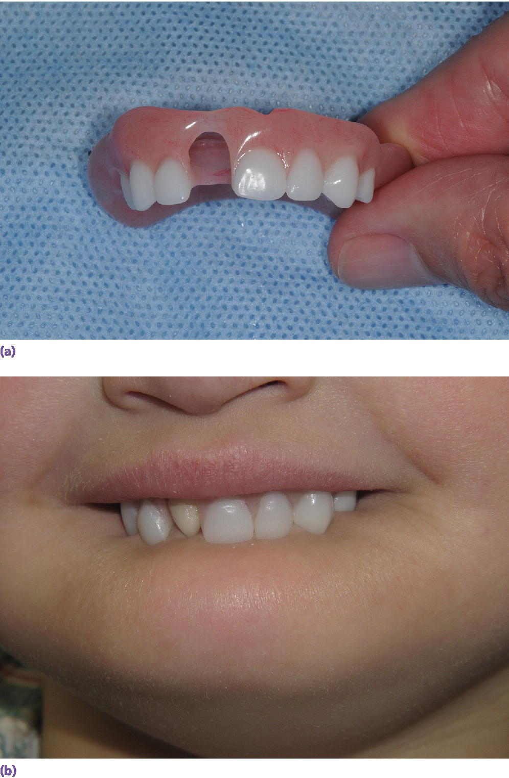 Photos displaying maxillary removable partial prosthesis (top) and a child biting his complete teeth (bottom).