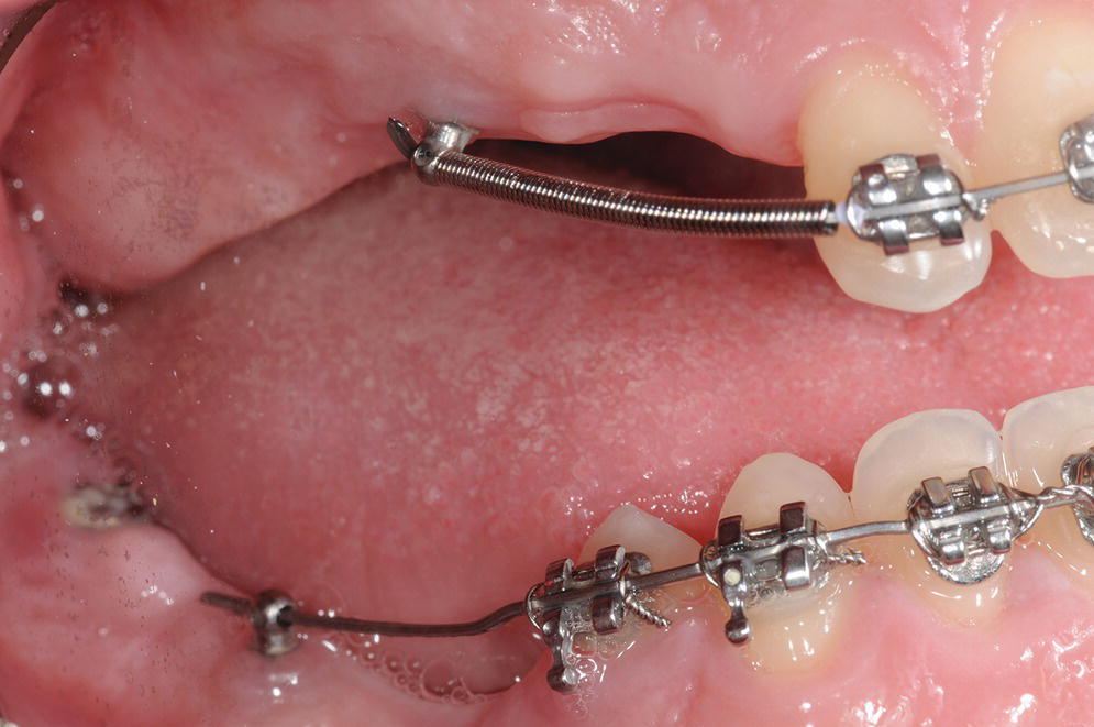 Photo displaying use of TADs to assist in anchorage for orthodontic movement of the four anterior teeth that patient formed.