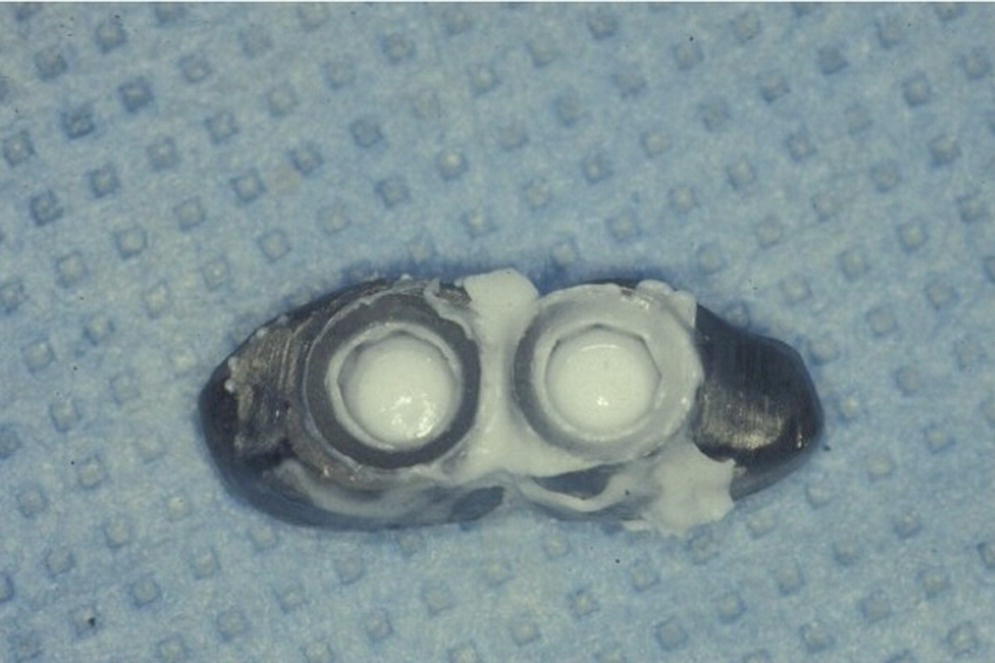 Photo depicting initial attempt at obtaining complete and passive seating of a splinted implant-supported restoration using silicone disclosing medium.