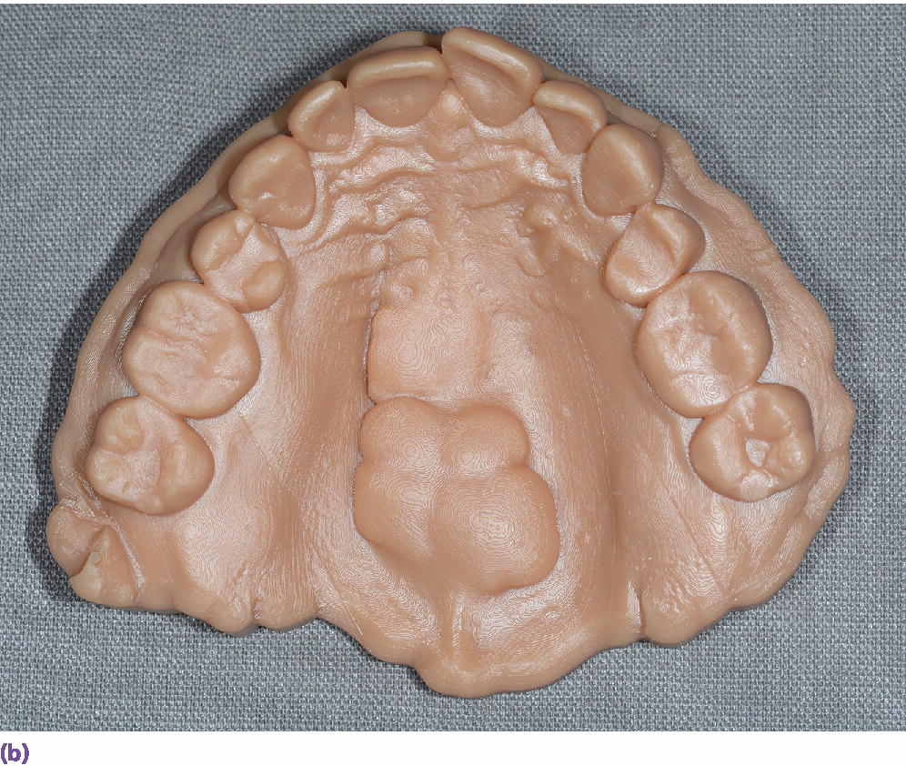 Photo displaying example of three-dimensionally printed casts maxillary cast with reproduction of maxillary torus.