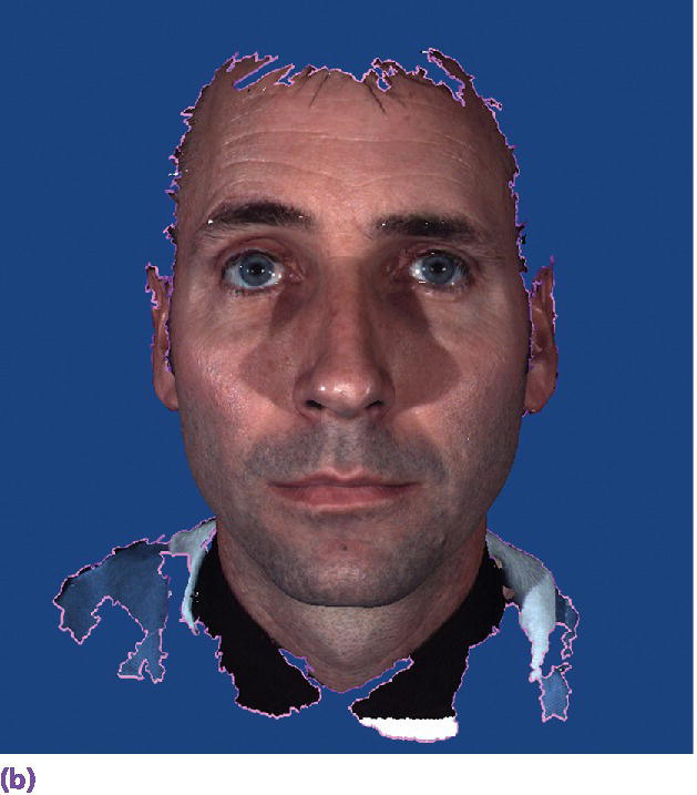 Photo displaying man's face in his extraoral 3D facial image.
