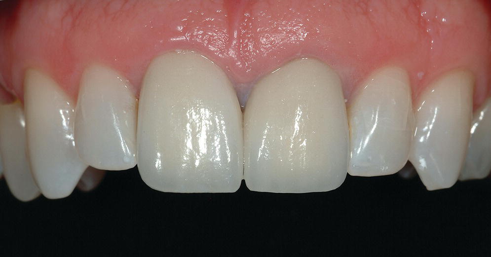 Photo depicting long-term milled CAD/CAM interim crowns for central incisor implants at the time of prosthesis delivery displaying facial view of teeth in maxilla.