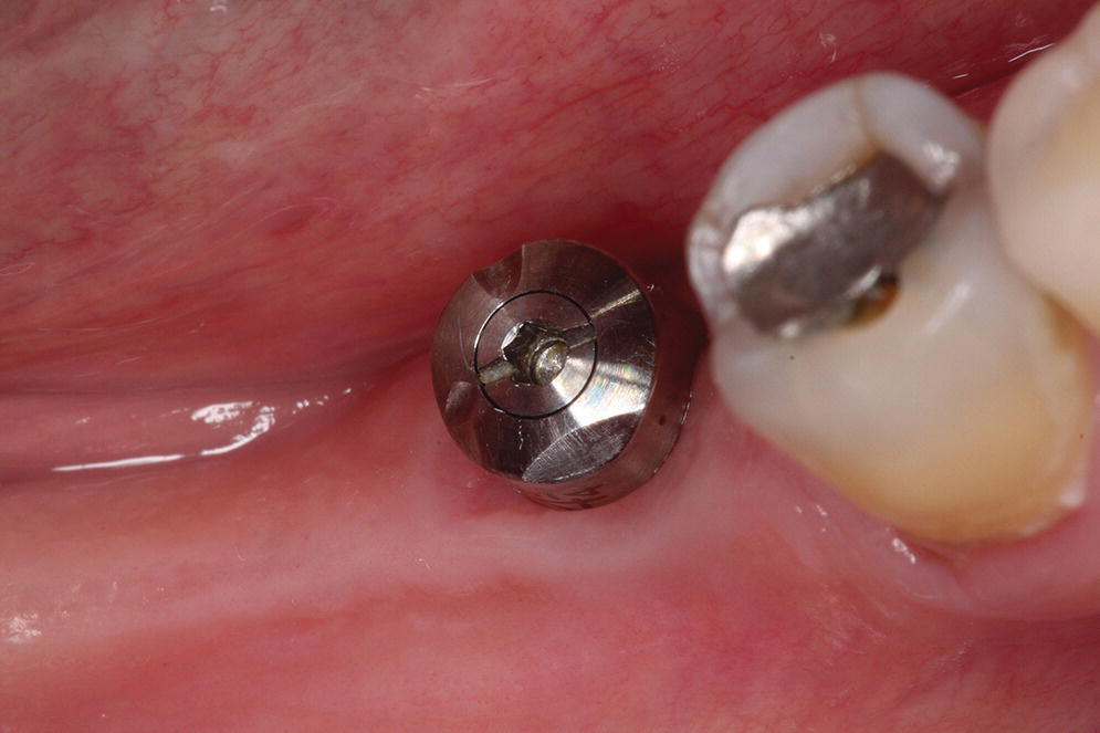 Photo displaying specialized healing abutment with milled patterns indicating implant depth, rotational timing, platform diameter, and external versus internal connection type.