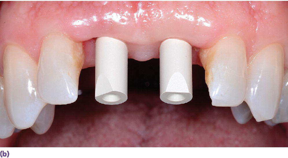 Photo displaying intraoral implant scanbodies for digital impressioning systems with two incisal bevels oriented to the facial for proper CAD software registration.