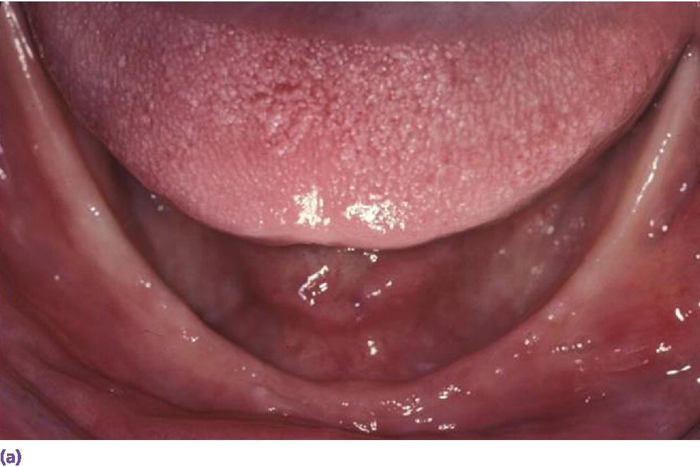 Photo of high muscle attachment negatively affecting the prognosis of a complete denture.