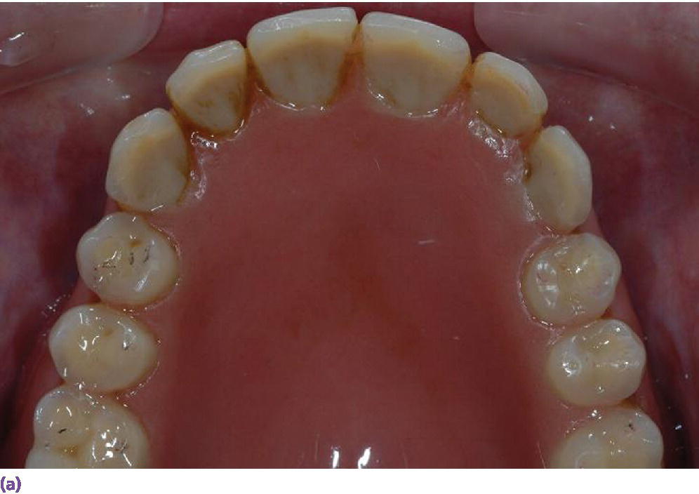 Photo depicting clinical situation of existing denture with adequate tooth position indicating mandible part.