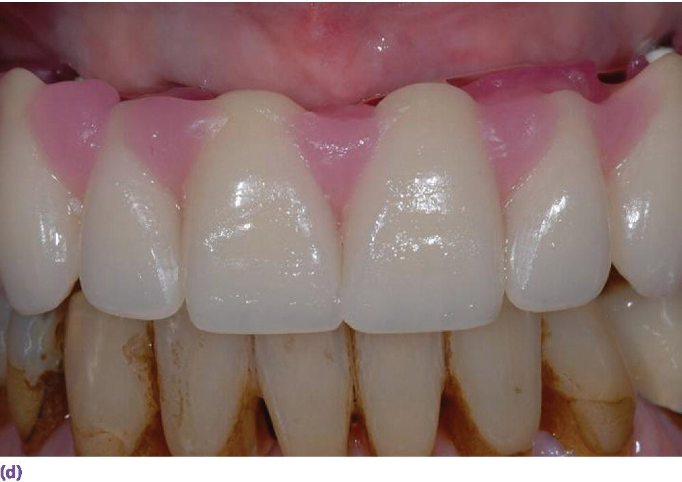 Photo displaying set-up made without buccal flange illustrating soft tissue support can only be provided by an implant overdenture (maxillary).