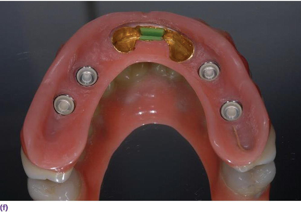 Photo displaying IOD retained at stud abutments (locators) and an anterior bar with an overcast.